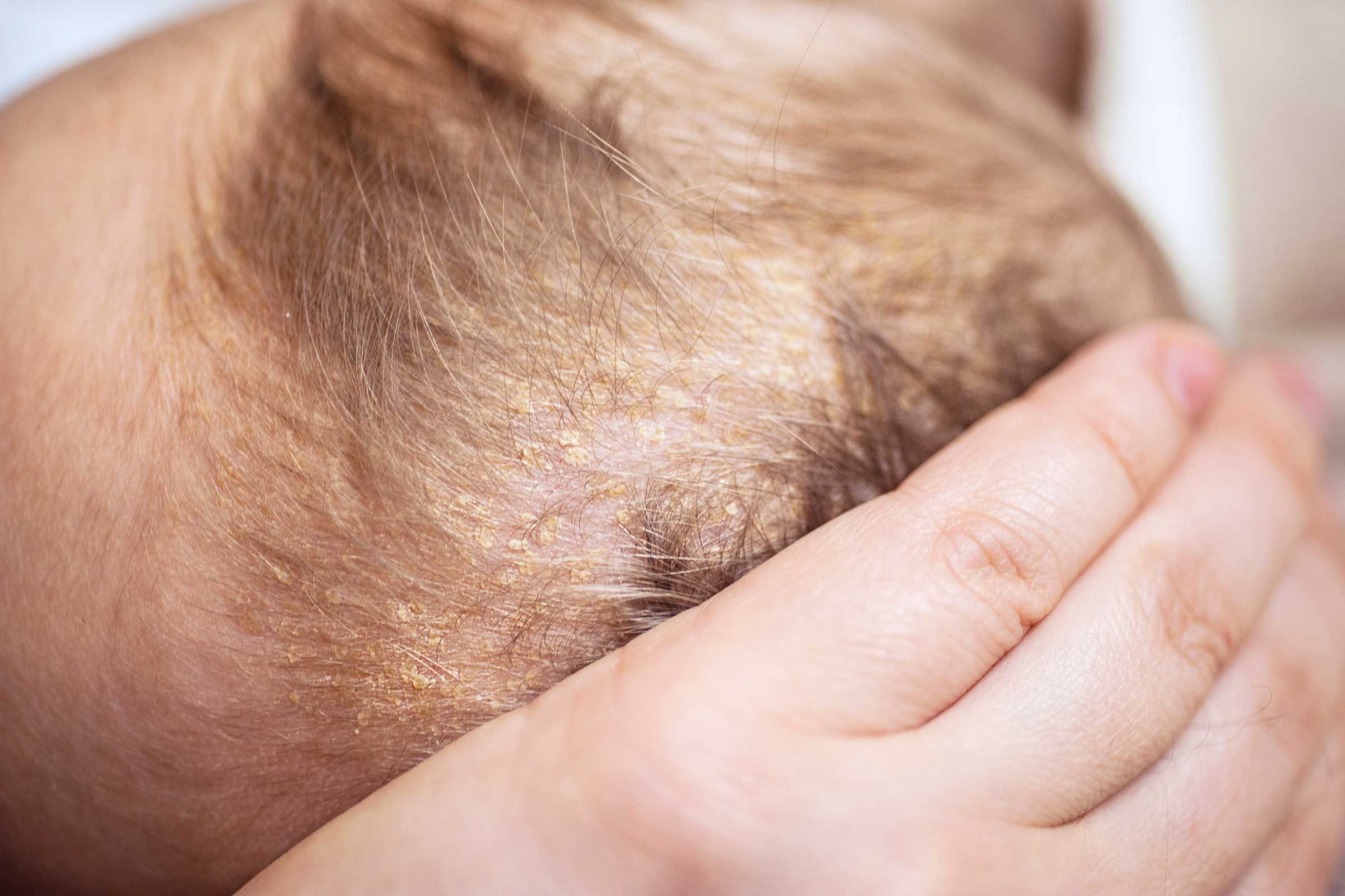 10_creative_baby_oil_treat_Cradle_cap_russaquarius