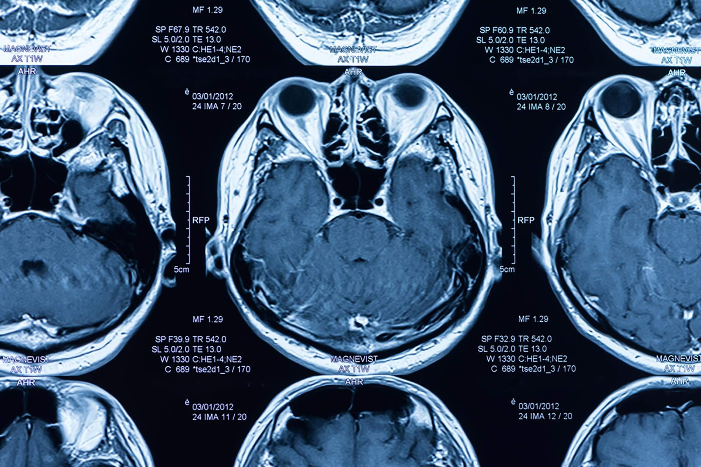 magnetic resonance image, mri scan of the brain.