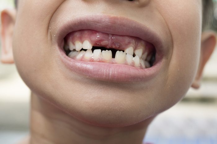 kid smile with lost tooth