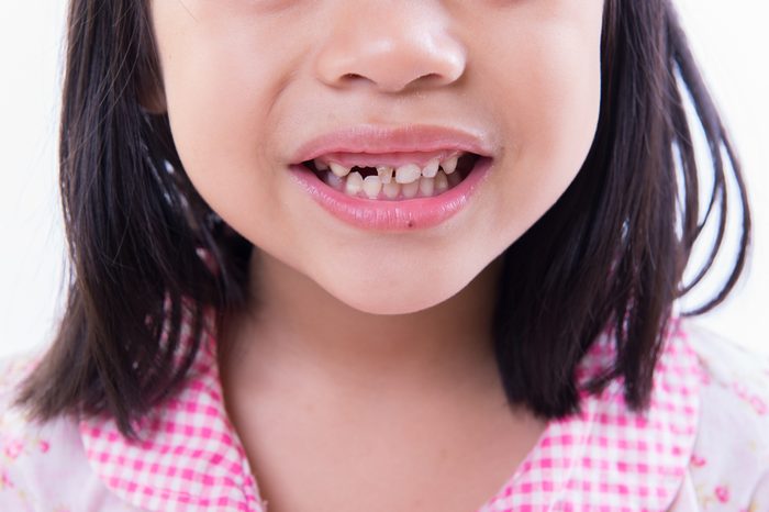 a child smile with missing teeth