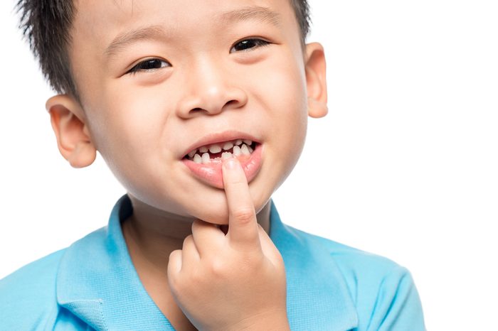 Lost milk tooth boy, Close up view.