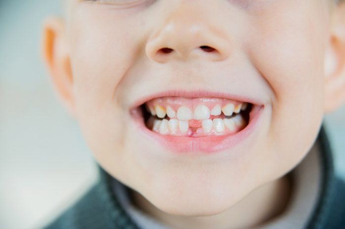 Childish cute mouth with beautiful lips and missing milk teeth dental health care and hygiene six years old toothless kid child closeup, horizontal picture