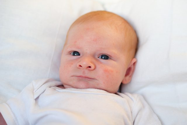 Infant acne, allergy, atopic dermatitis on the face of a baby