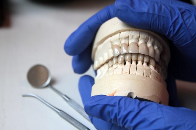 gypsum model of jaw 