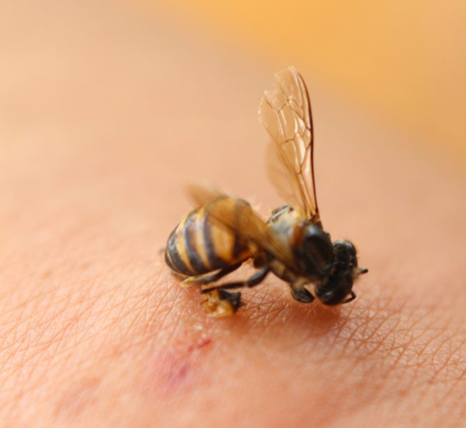 wound bee sting on men's arms.Swelling and inflammation