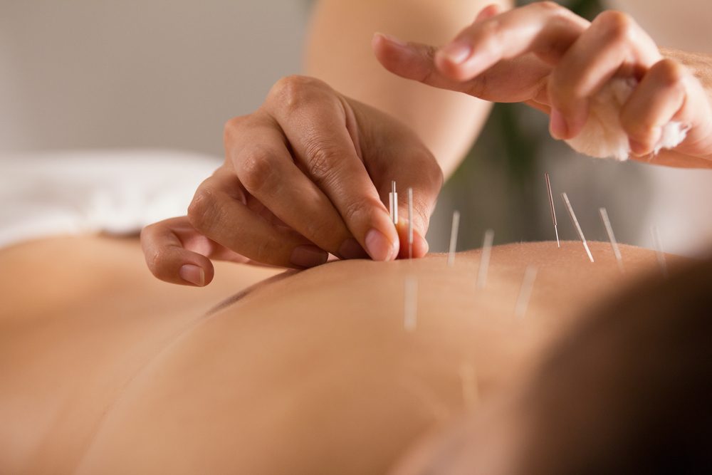 Hands insert acupuncture needles into a person's bare back, creating a calming therapeutic setting.