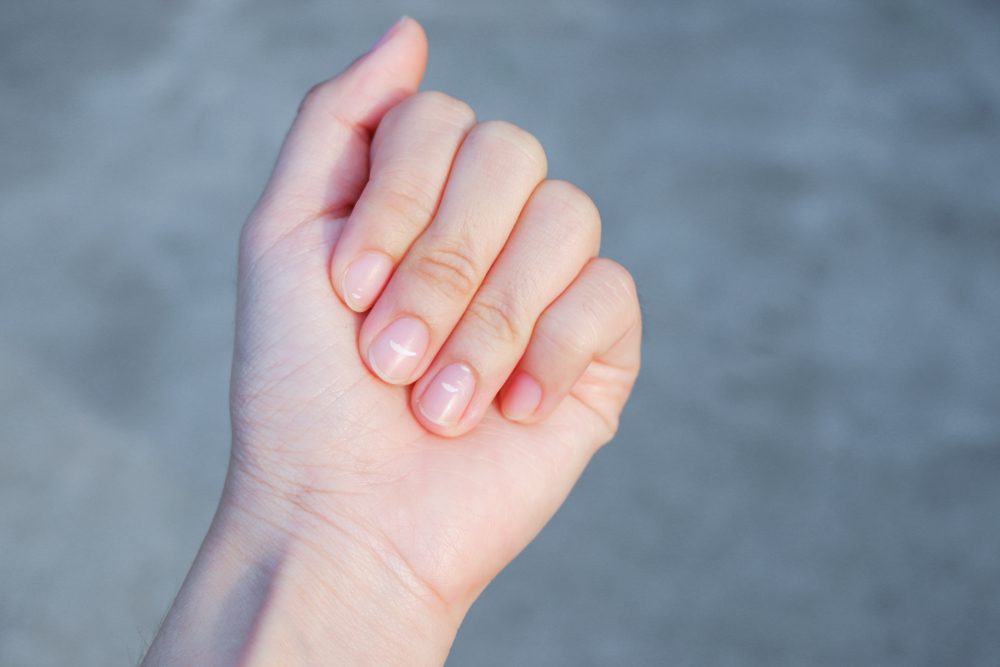 White spot on the woman's fingernail, Revealed about the health caused by calcium deficiency. This disease is called leukonychia.