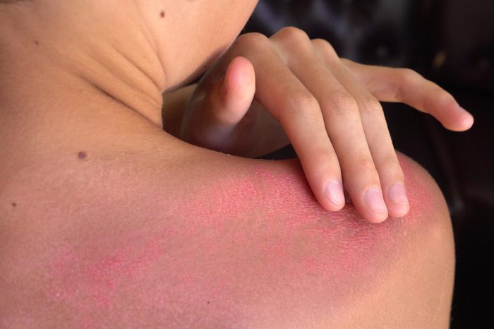A young man with severe sunburn. Sunburn treatment: special burn ointment, salve, cream, gel. Burned skin