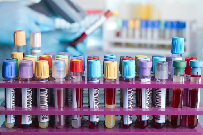 rack of blood tubes with barcode labels for proper identification and background hand of laboratory technician holding a blood tube for scan / Tray with tubes with blood samples labeled