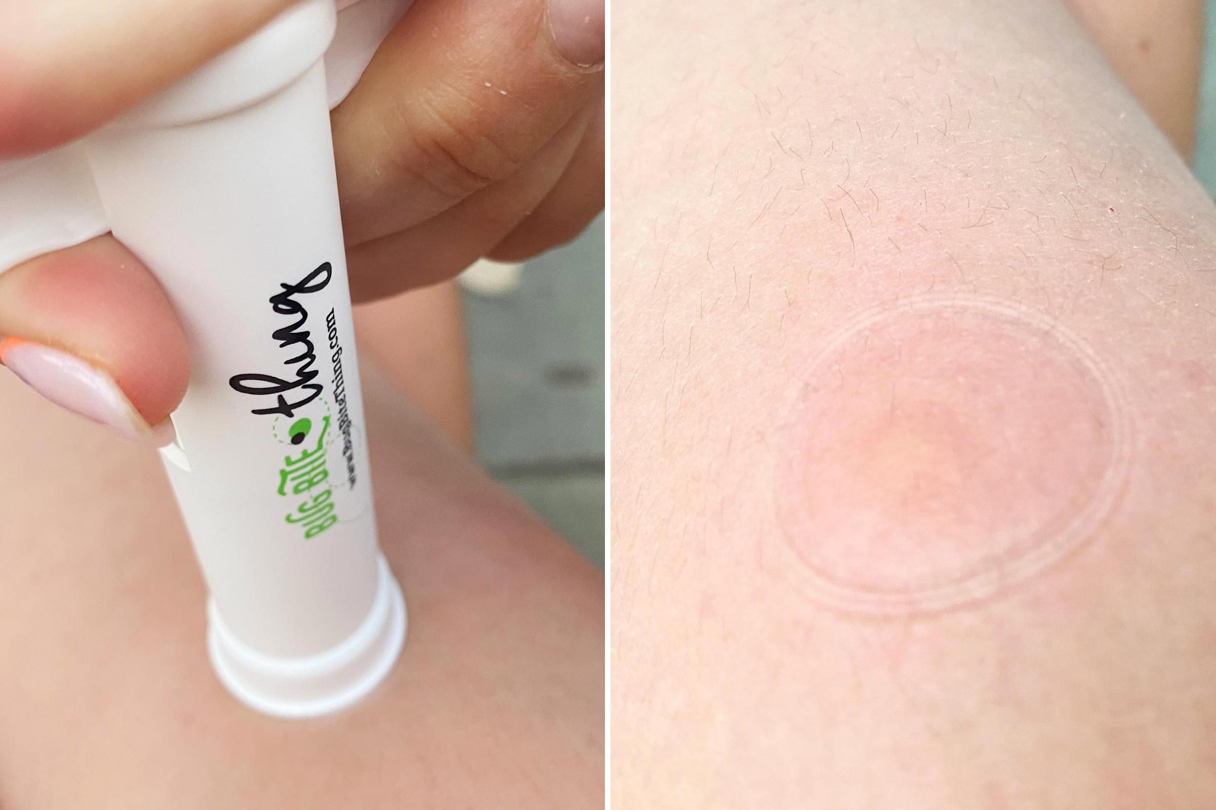 Device on skin extracts, leaving circular mark; text reads "Bug Bite Thing."